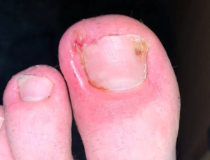 An ingrown toenail