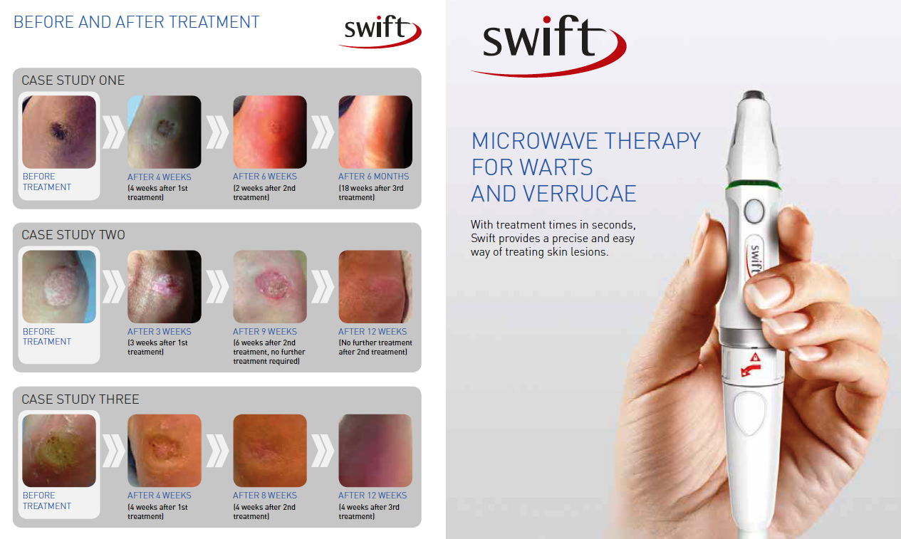 What is Swift Verruca Treatment? One Step Ahead Podiatry