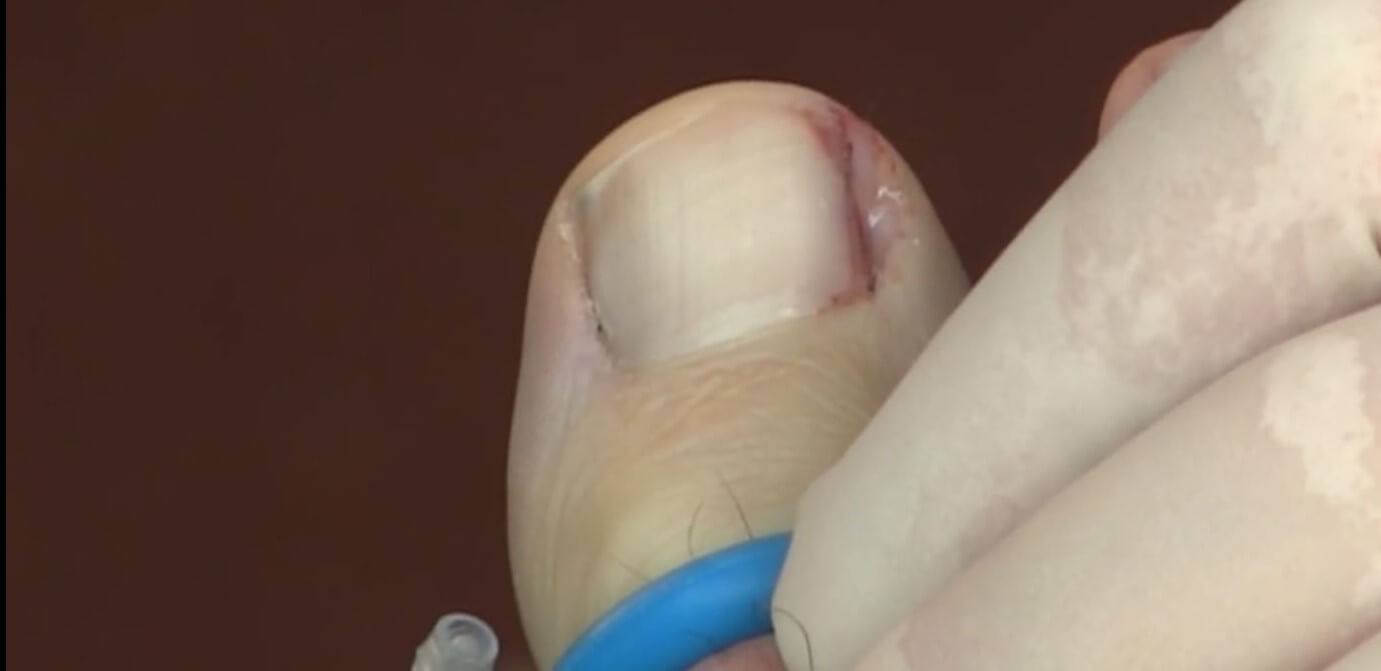 Nail Inposed Nail Surgery for Ingrowing Nails - How it works - One Step Ahead Podiatry