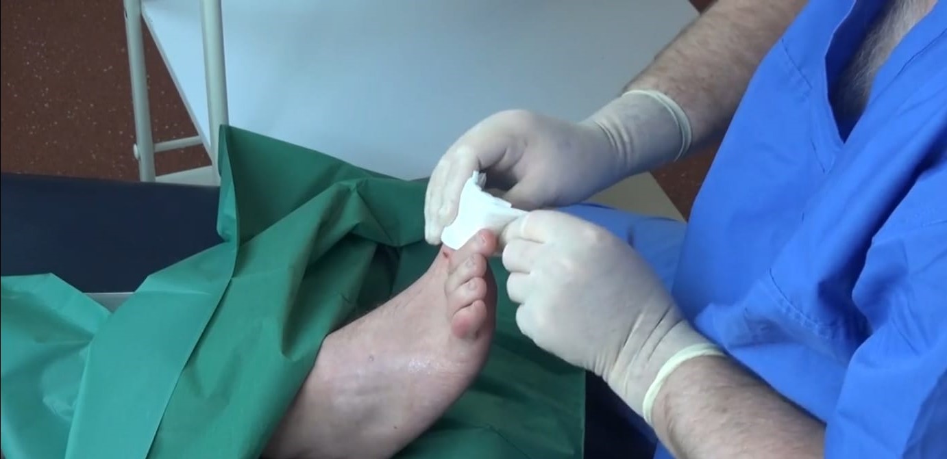 Nail Surgery For Ingrowing Nails - How It Works - One Step Ahead Podiatry