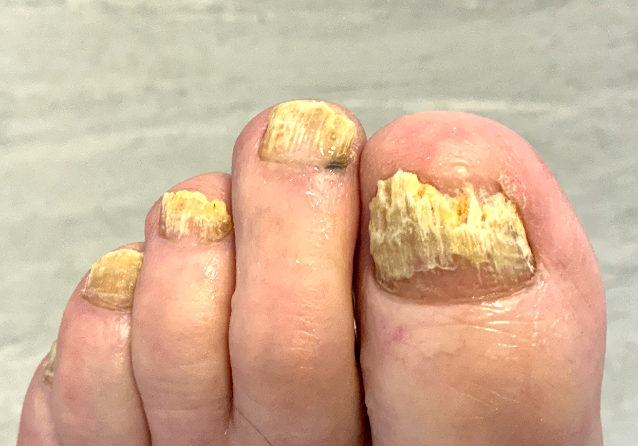 Toes with a fungal infection